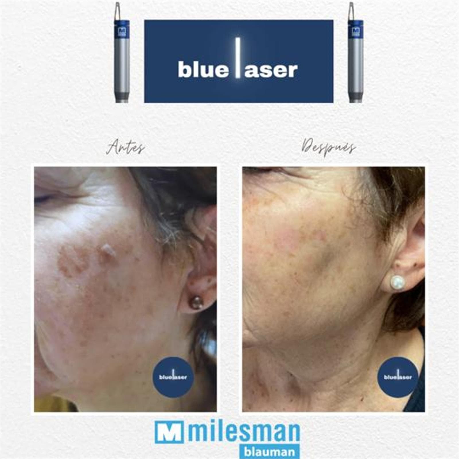 BLAUMAN: Láser azul 13 enero - Imagen 1