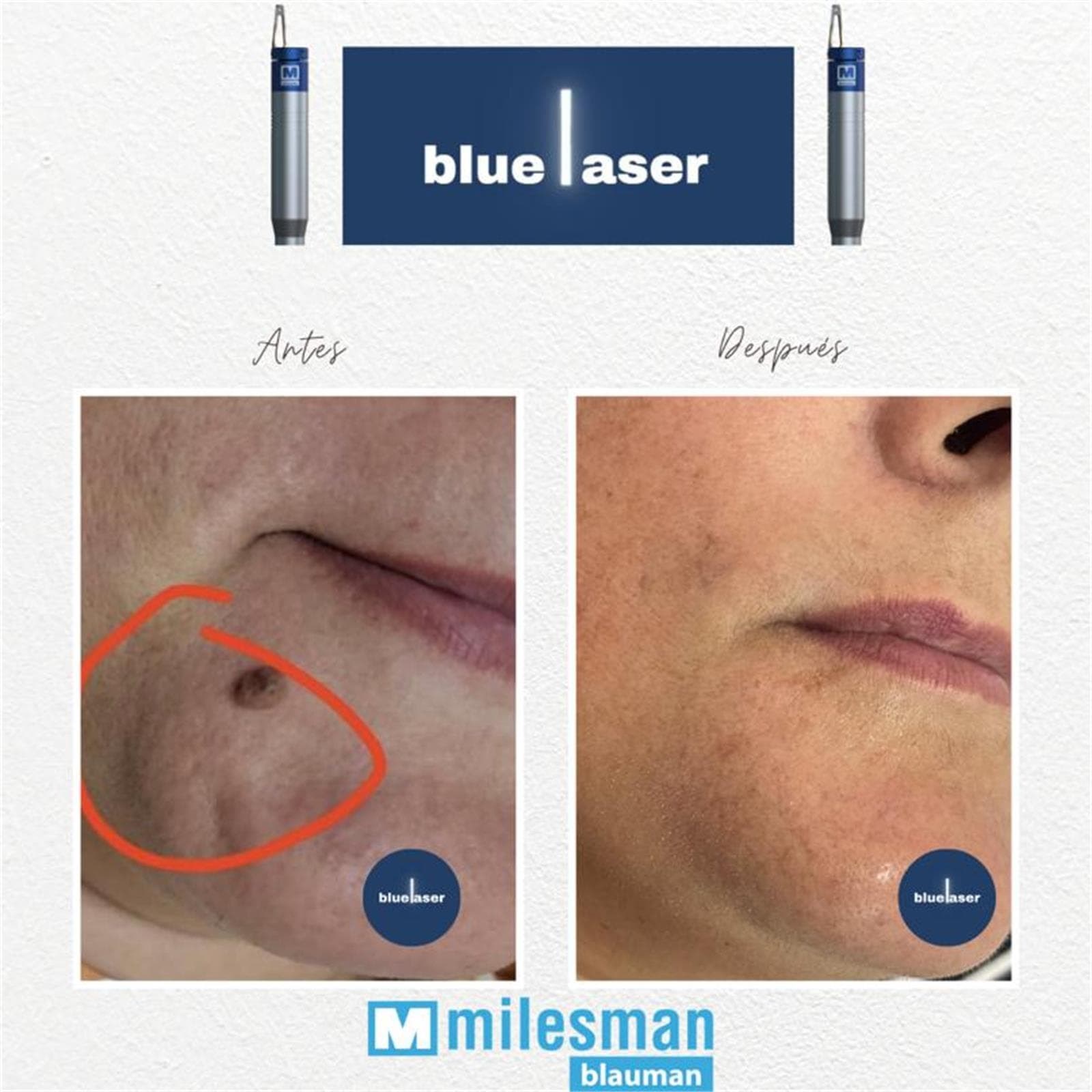 BLAUMAN: Láser azul 13 enero - Imagen 2