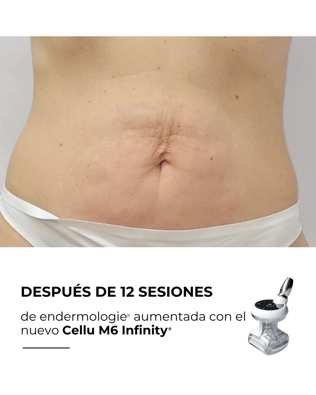 Tratamiento LPG Infinity en Tui